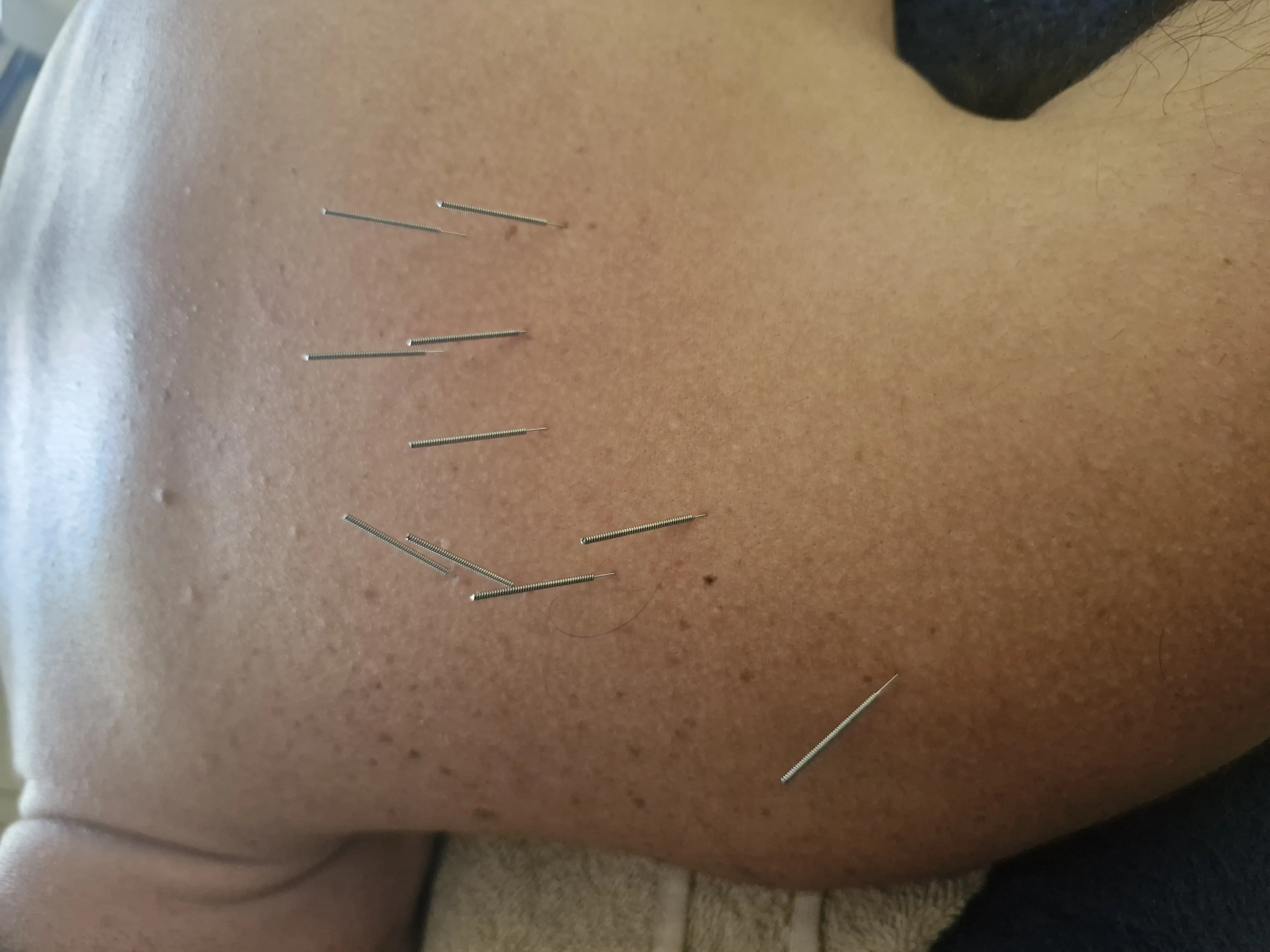 Fisioterapia dor cronica